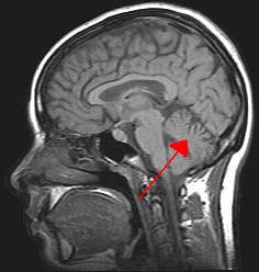 3122485-Cerebellum.jpg