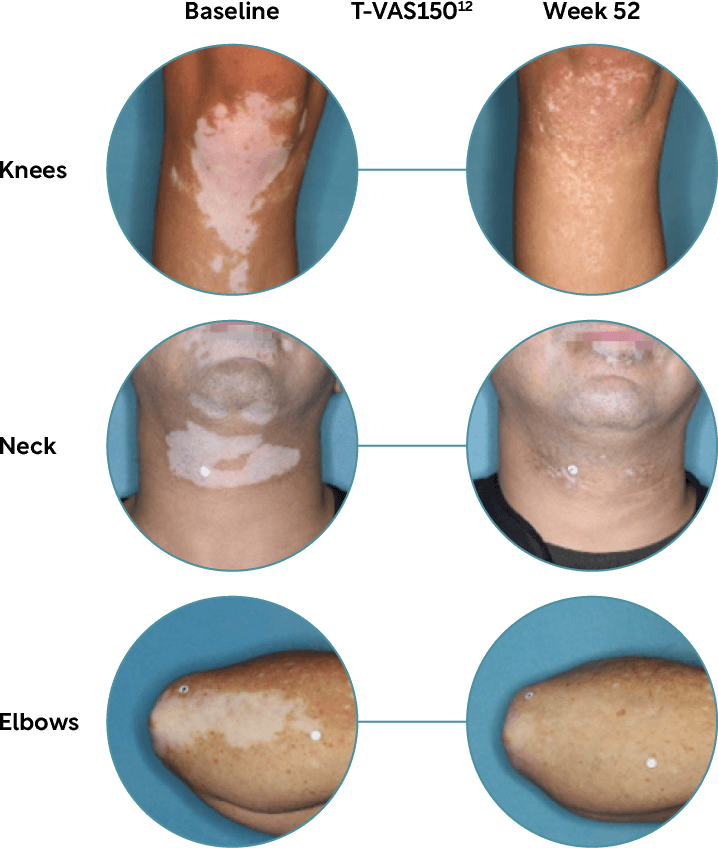 overall-body-repigmentation-mobile.png